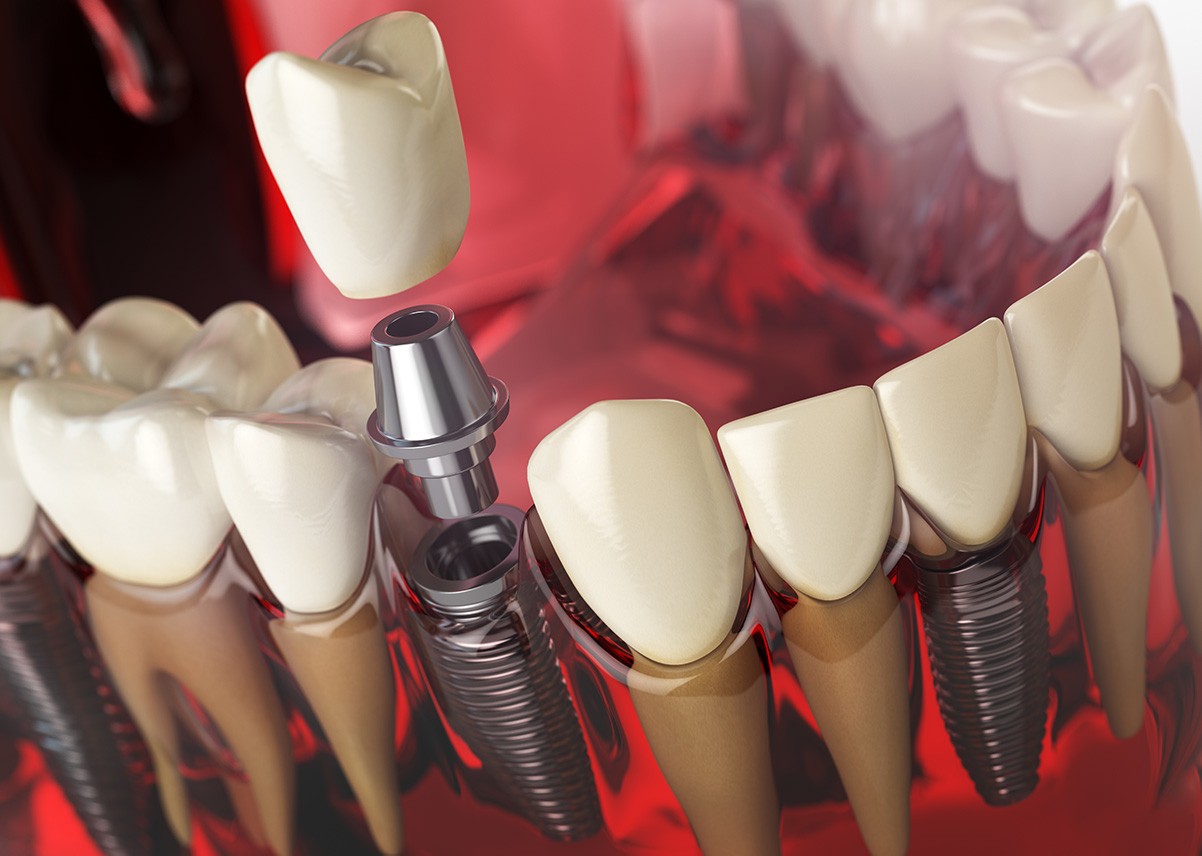 dental-implants-how-many