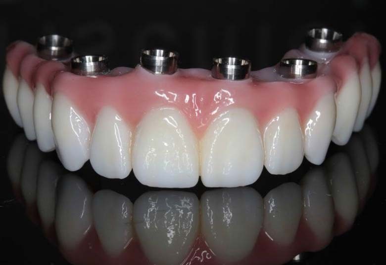 full-mouth-implants-los-angeles-full-arch