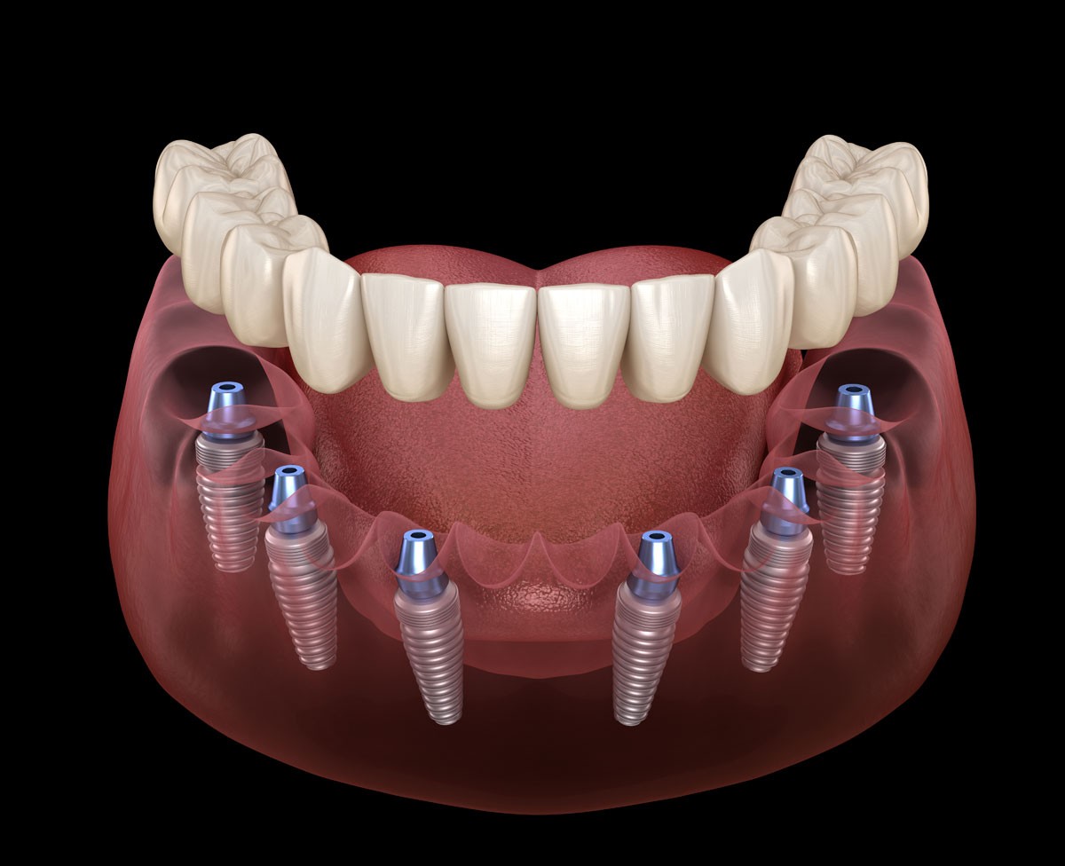 all-on-all-on6-dental-implants