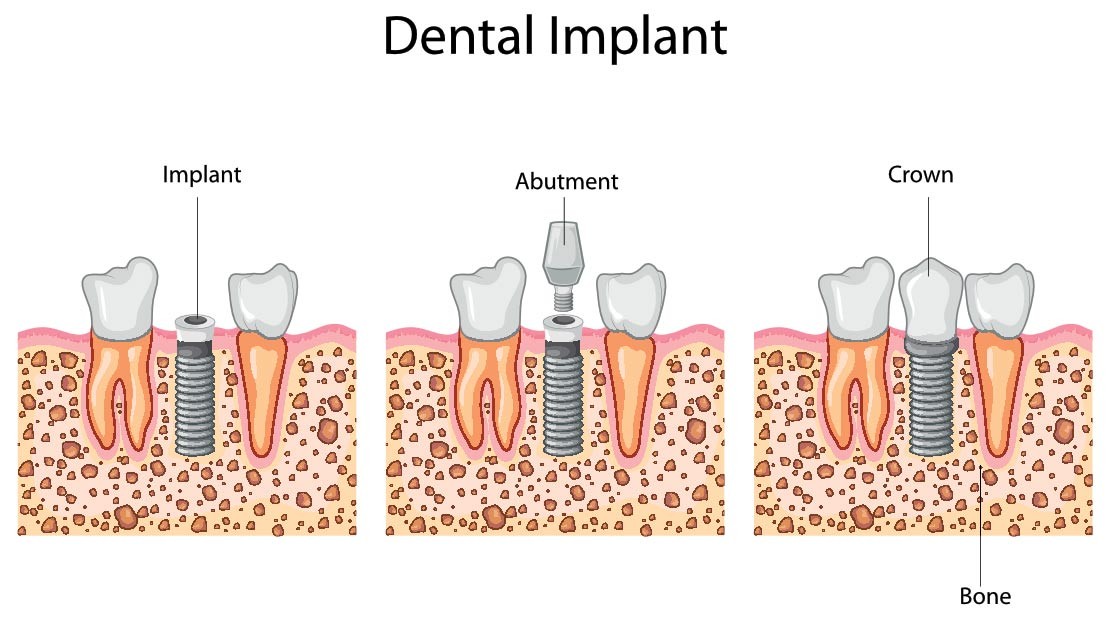 dental-implants-process
