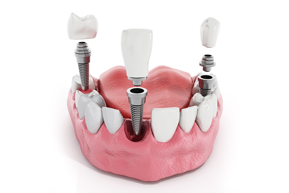 failed-dental-implants