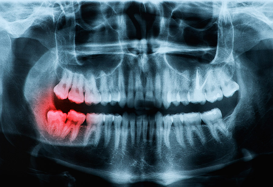 Impacted Wisdom Teeth Removal Cost Without Insurance 2021