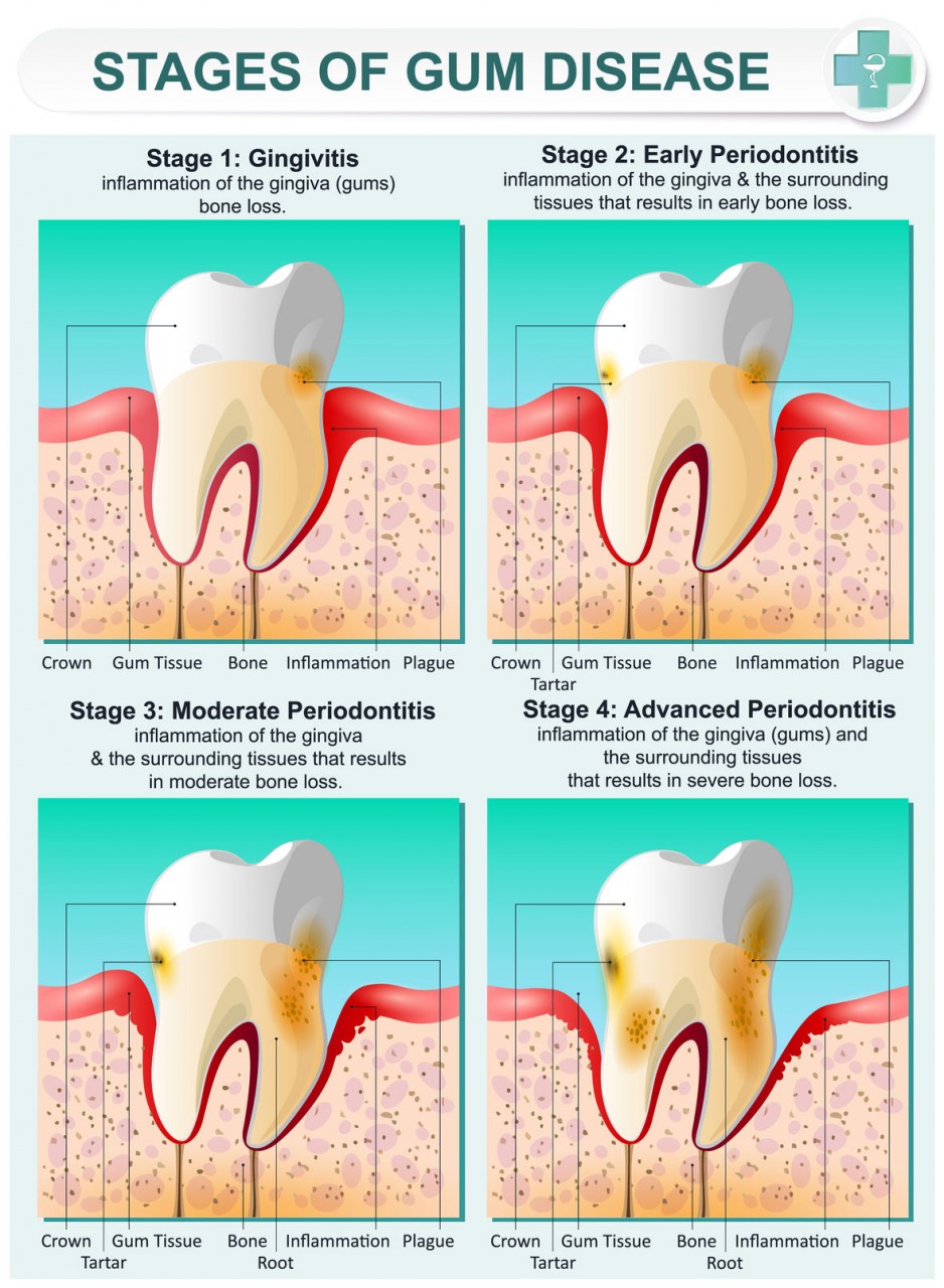 Infographic Stages Of Gum Disease Welcome To Dr Arman Torbatis