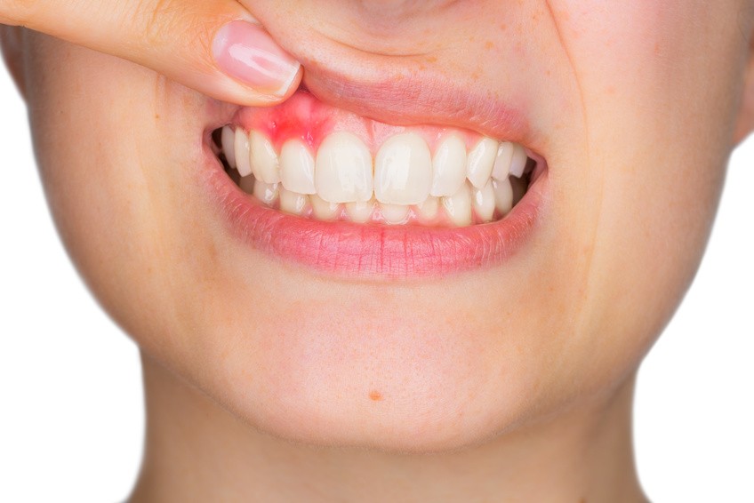 Ulejlighed Ældre borgere officiel The Effects of Aggressive Tooth Brushing - Welcome to Dr. Arman Torbati's  Dental Blog - Los Angeles Prosthodontist, Aesthetic & Implant Dentistry