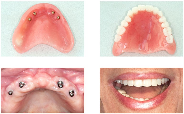 dental-implants-before-after