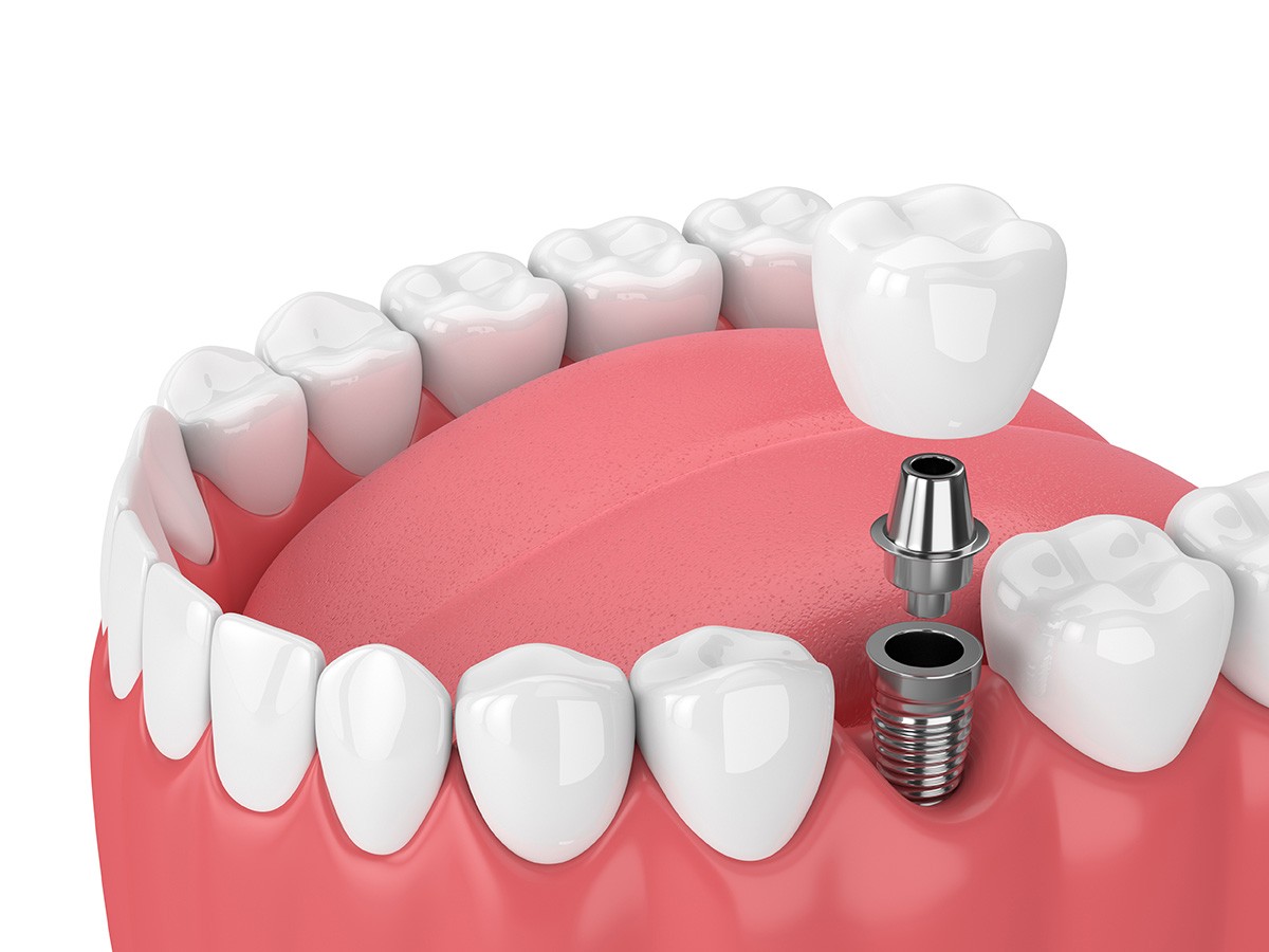 dental implants Los Angeles